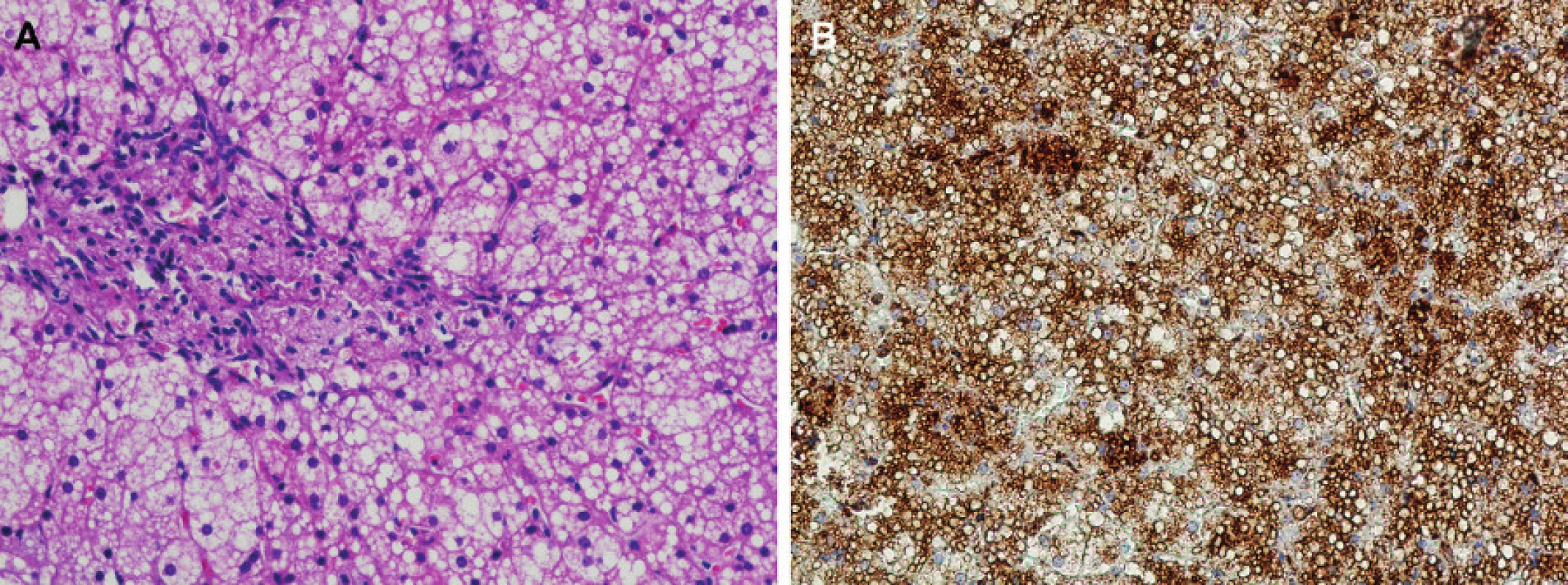 Typický nález jaterní biopsie u 2leté dívky s diagnózou CESD.
(A) Mikrovezikulární uniformní steatóza hepatocytů. Masivní infiltrace portálního pole střádajícími makrofágy a portální fibróza. Barvení HE, zvětšení 20x.
(B) Imunohistochemická detekce lysosomálního markeru LAMP2 demonstrující výraznou expanzi lysosomálního systému hepatocytů a intralysosomální lokalizaci střádaných kapének neutrálních lipidů. Zvětšení 20x.
Fig. 1. Fig. 1. Typical finding of liver biopsy in a 2-year girl with CESD diagnosis.
(A) Microvesicular uniform steatosis of hypatocytes. Massive infiltration of the portal field by storing macrophages and signs of portal fibrosis are apparent. HE staining, objective 20-fold.
(B) Immunohistochemical detection of lysosomal marker LAMP2 demonstrating a marked expansion of the hepatocyte lysosomal system and intralysosomal localization of the stored droplets of neutral lipids. Objective 20-fold.