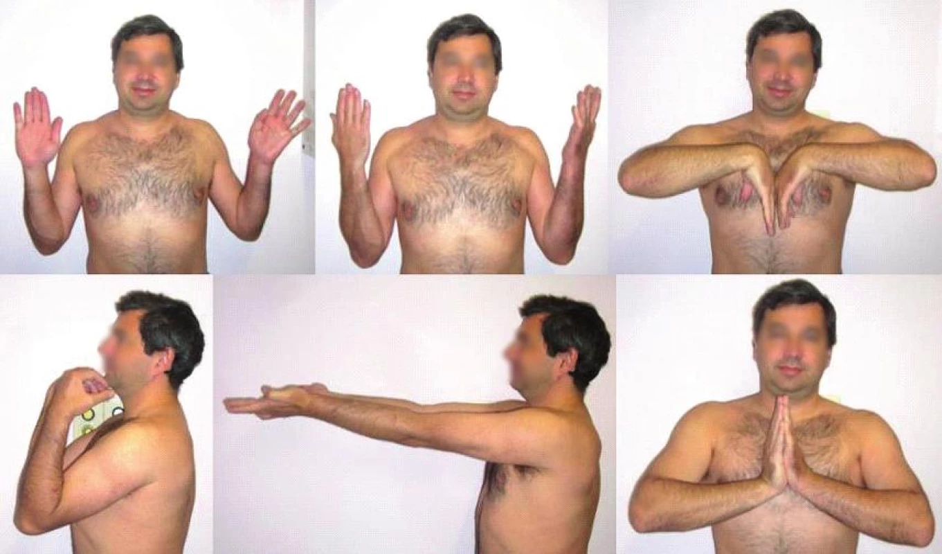 Funkční výsledek u pacienta z Obr. 12 za rok po úrazu 
Fig. 13: Functional result in the patient from Fig. 12 one year after the injury