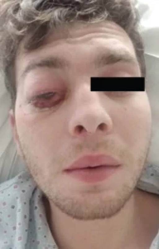 Pacient při příjmu na oddělení. Patrná protruze pravého bulbu a značná chemóza spojivky.