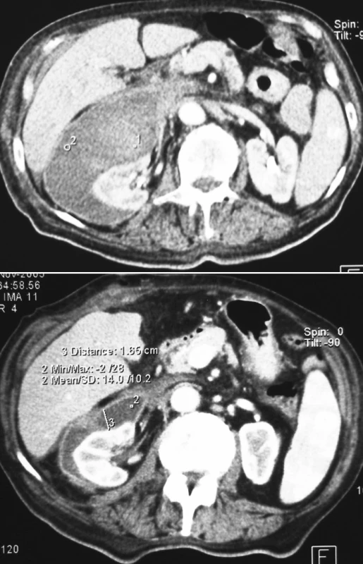 a, b. Pacient č. 1. CT obraz retroperitoneálneho hematómu medzi pravou obličkou a pravým lalokom pečene
Pic. 2a, b. Patient Nr. 1: A CT scan revealing a retroperitoneal hematoma between the right kidney and the right liver lobe