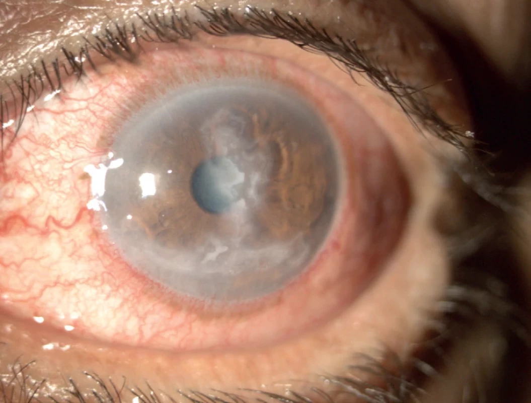 Geographic herpetic corneal ulcer in a patient treated with topical corticosteroids