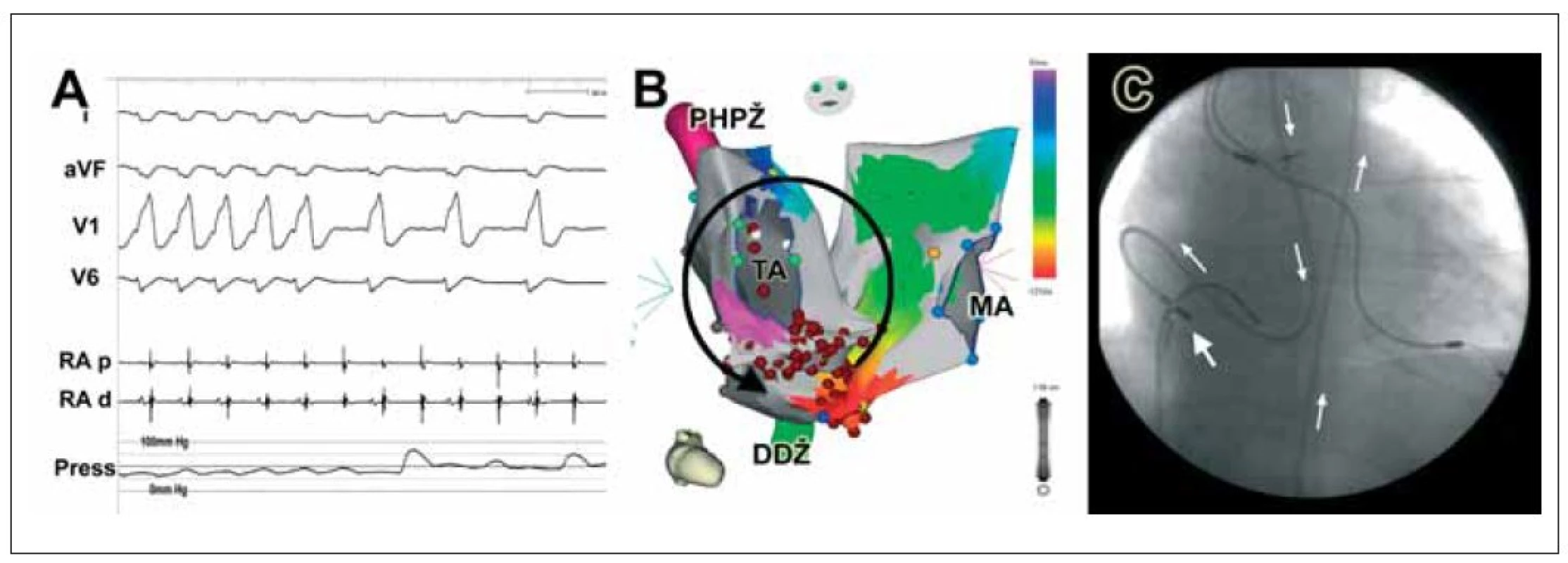 (A) EKG-záznam spolu s invazivním měřením tlaku u pacienta s tachykardií typu reentry po Mustardově korekci transpozice velkých cév. Při převodu arytmie v poměru 1 : 1 na komory dochází k výraznému poklesu systolického krevního tlaku na hodnoty okolo 50 mm Hg. (B) Aktivační mapa obou srdečních síní u stejného pacienta při typickém flutteru síní. (C) Vpravo je zobrazen průběh ablačního katétru (šipky), který je zaveden retrográdně přes aortu a systémovou pravou komoru do síně plicních žil.