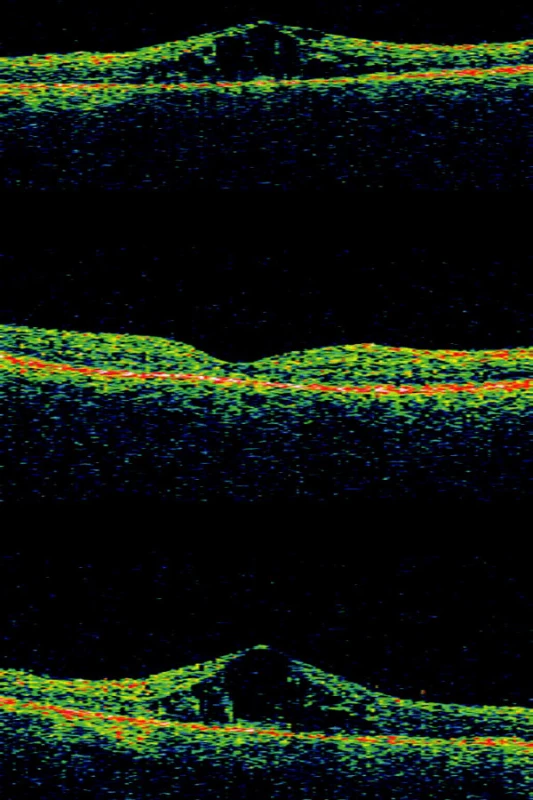 OCT pacienta ze skupiny 4 (TK nad 180/110 mmHg) před, 1 a 6 měsíců po intravitreální injekci triamcinolonu