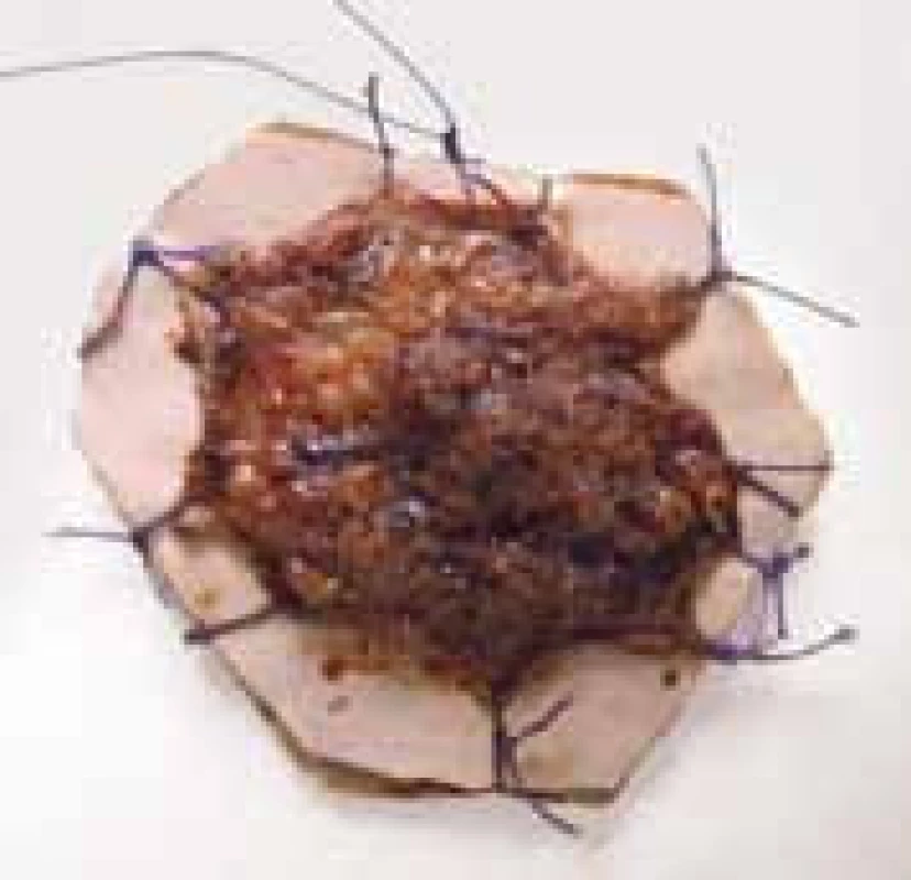 Preparát exofytického tumoru rekta připravený k histologickému vyšetření, dlouhý steh označuje orální část preparátu.
Fig. 3. Exofytic tumor slide prepared for histologic examination, upper part marked by long stitch.
