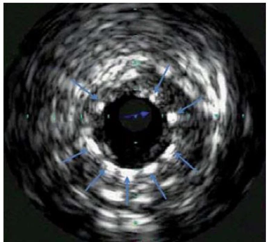 IVUS věnčité tepny po implantaci stentu, šipky označují struty stentu, sonda Eagle Eye<sup>®</sup>, Volcano.