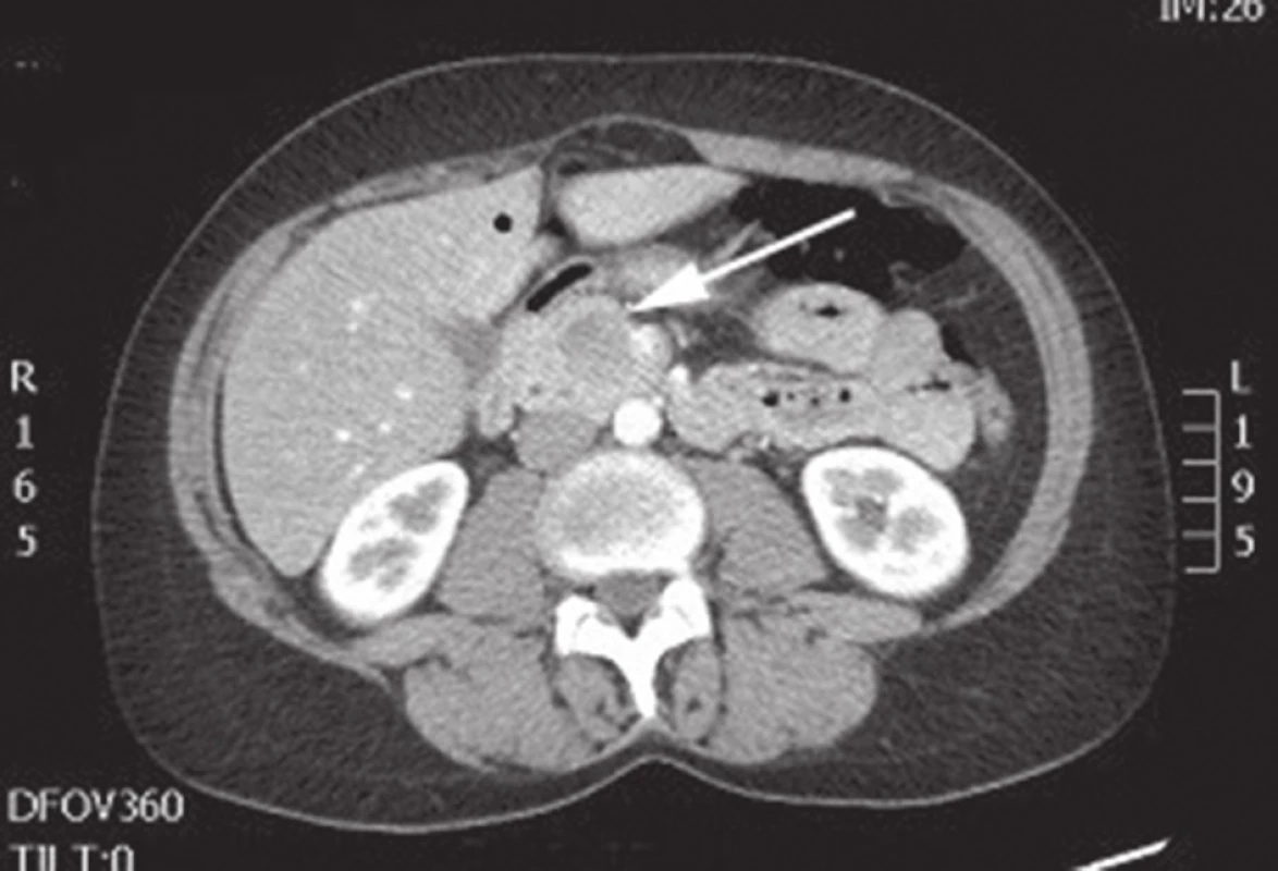 CT břicha s nálezem SPN v oblasti hlavy pankreatu
Fig. 3: Abdominal CT with the finding of SPN of the head of the pancreas