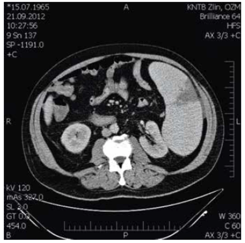 Splenomegalie s infarktem sleziny.