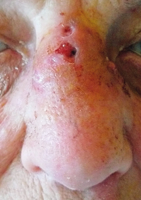 Nález při přijetí: zarudnutí a píštěle na hřbetu a kořeni nosu.