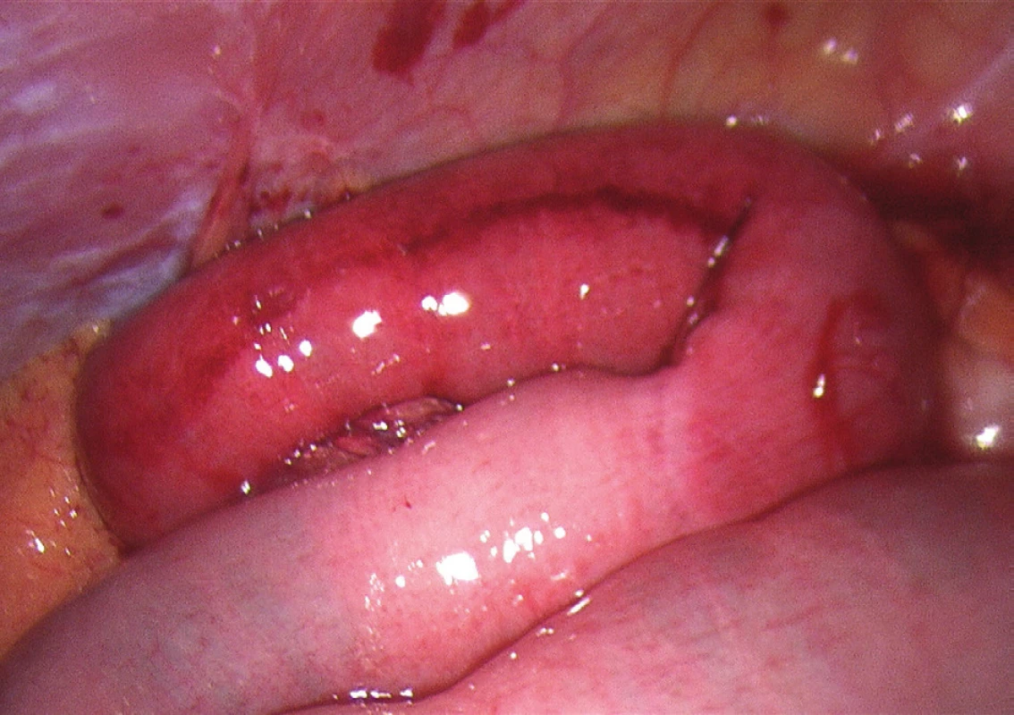 Laparoskopický obraz uskřinuté kličky tenkého střeva po jejím uvolnění
Fig. 4: Laparoscopic image of the incarcerated small intestine loop after release