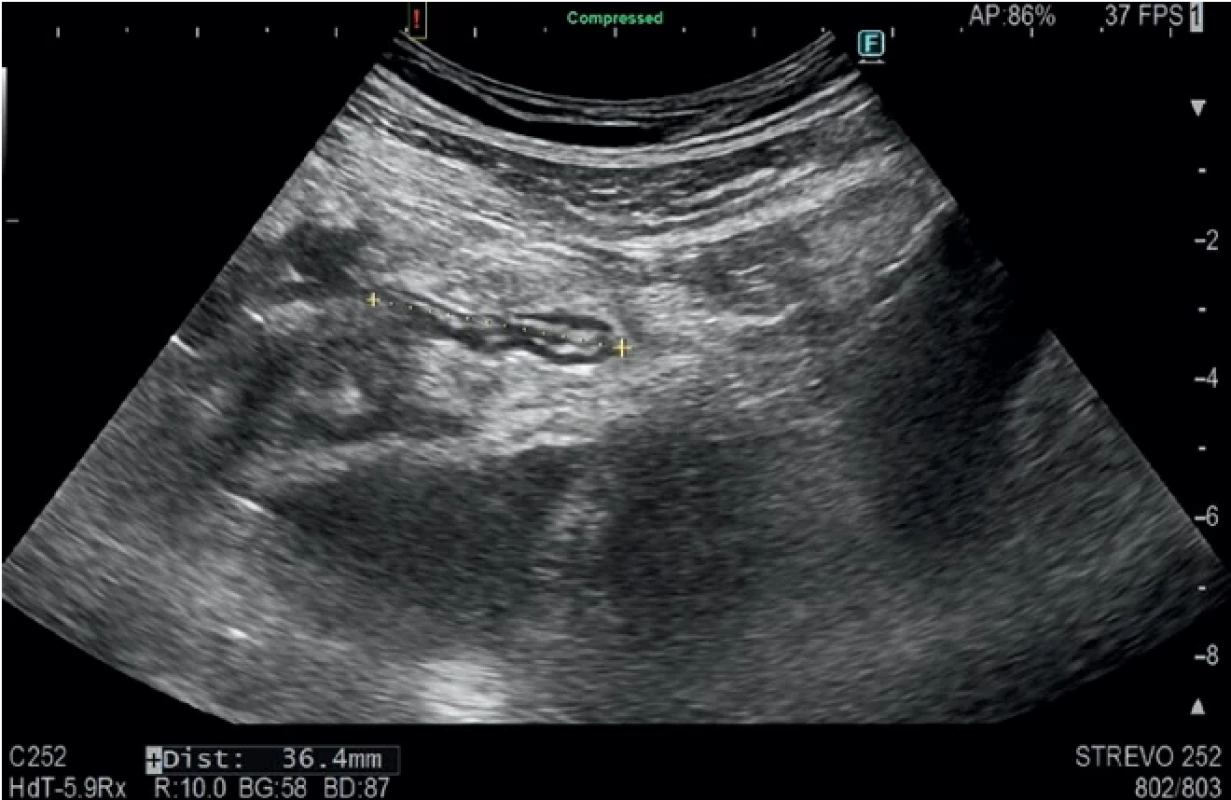  Appendix vermiformis v infiltrátu na UZ.  An ultrasound picture of appendix surrounded by an infiltrate.