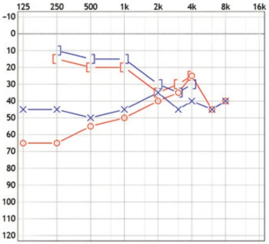 Předoperační audiogram. Oboustranná smíšená nedoslýchavost, kochleární rezerva 35 dB vpravo a 40 dB vlevo na frekvencích 125–1 000 Hz. Na frekvenci 2 000 Hz oboustranně patrný Carhartův zub. Fig. 1. Preoperative audiogram. Bilateral mixed hearing loss with an airbone gape up to 35 dB in the right ear and 40 dB in the left ear at 125–1,000 Hz. The Carhart notch is observed at 2,000 Hz.