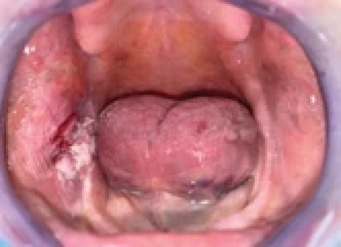 Verrucous squamous cell carcinoma of the right retromolar and buccal region.
