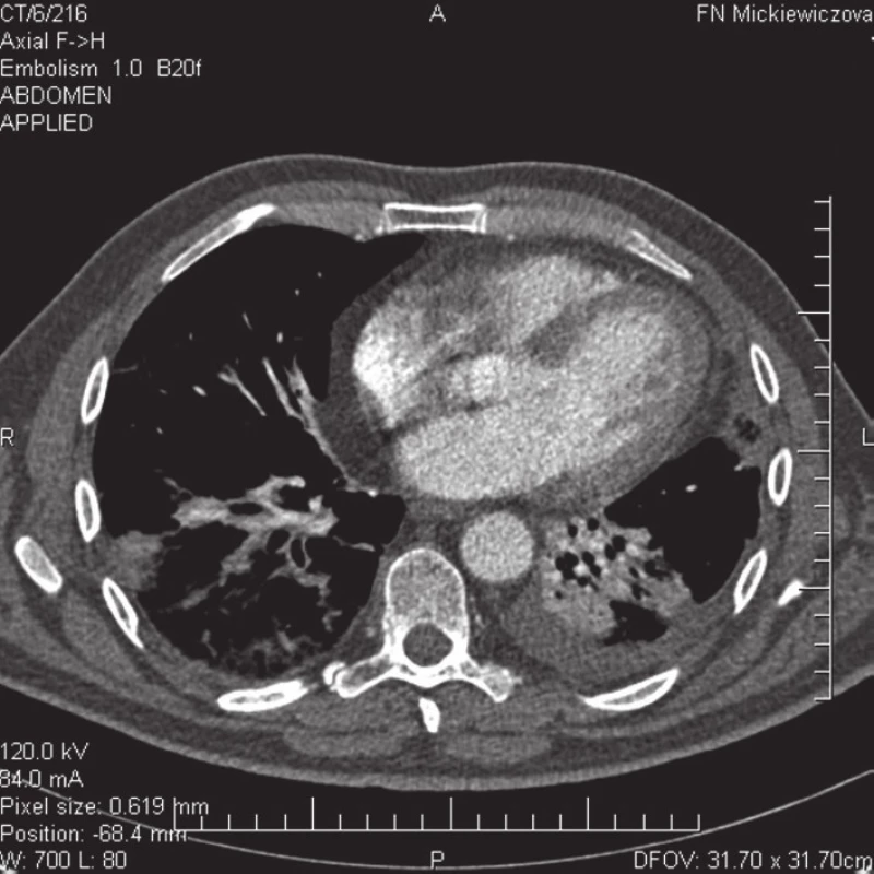 CT pulmangiografia – embolizácia do segmentálnych artérií a. pulmonalis pre dolný lalok vpravo spolu s kondenzáciami a atelektázami pľúcneho parenchýmu, atelektáza v oblasti dolného laloka vľavo.