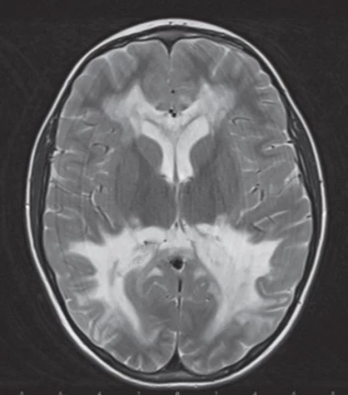 Rozsáhlé symetrické demyelinizační léze (hyperintenzity) v parietookcipitální oblasti mozku v T2 vážené projekci na MR u 12letého chlapce s pozdě diagnostikovanou cerebrální formou X-vázané adrenoleukodystrofie a Loesovým skórem 18 bodů.