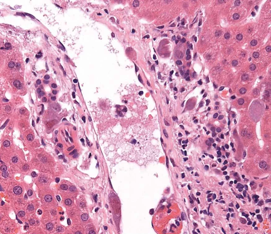 CMV infekce. Virové jaderné inkluze v endoteliích a biliárních epiteliích. Barveno hematoxylinem eozinem (zvětšení 200x).