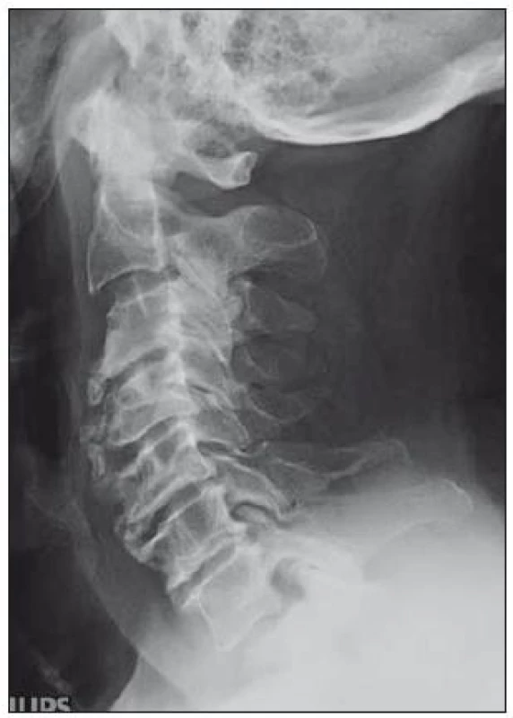 Těžké spondylózní měny C páteře.