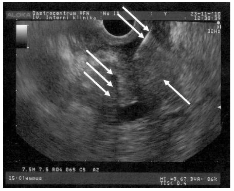 EUS obraz objemného nádoru hlavy pankreatu (↑), zavedená bioptická jehla (↑↑); plastový biliární stent s aerobilií (↑↑↑)