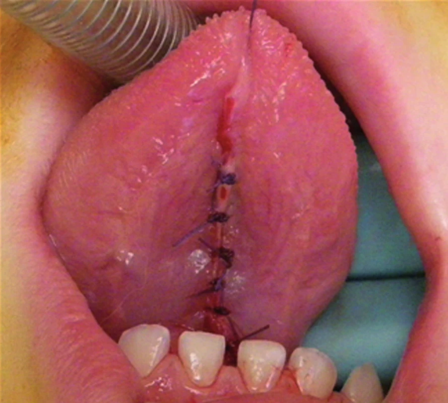 Stav po frenulektomii – sutura jednotlivými stehy.
Fig. 3. Status after frenulectomy: suture by individual stitches.