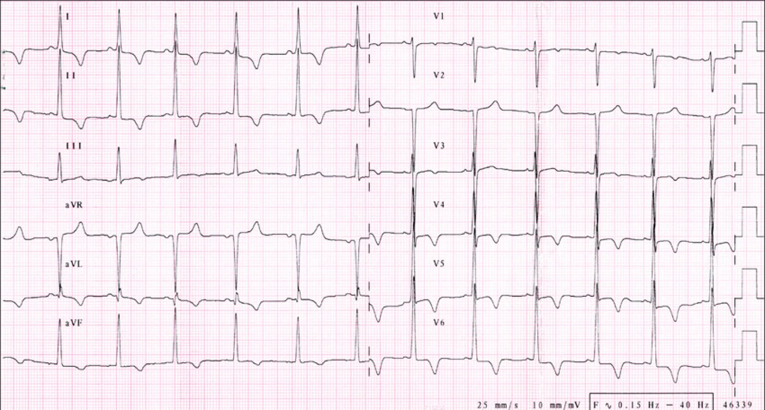 IS, 25 let, obraz hypertrofické kardiomyopathie.
EKG nález splňuje voltážová kriteria pro hypertrofii LK, dále negativní T vlny ve svodech I,II, aVL, aVF, V4-6, malá denivelace ST V5-6. Echokardiograficky rozměr septa 37 mm, známky obstrukce s gradientem 95 mm Hg. Pacientce byl preventivně implantován kardioverter defibrilátor z primárně preventivní indikace (sestra s hypertrofickou kardiomyopathií resuscitována pro náhlou srdeční zástavu).
