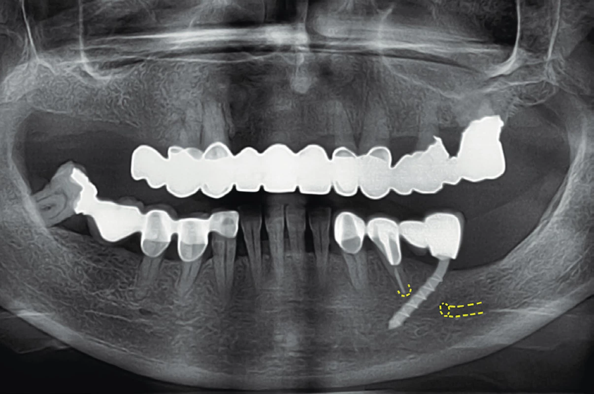 „Bypass foramen mentale“