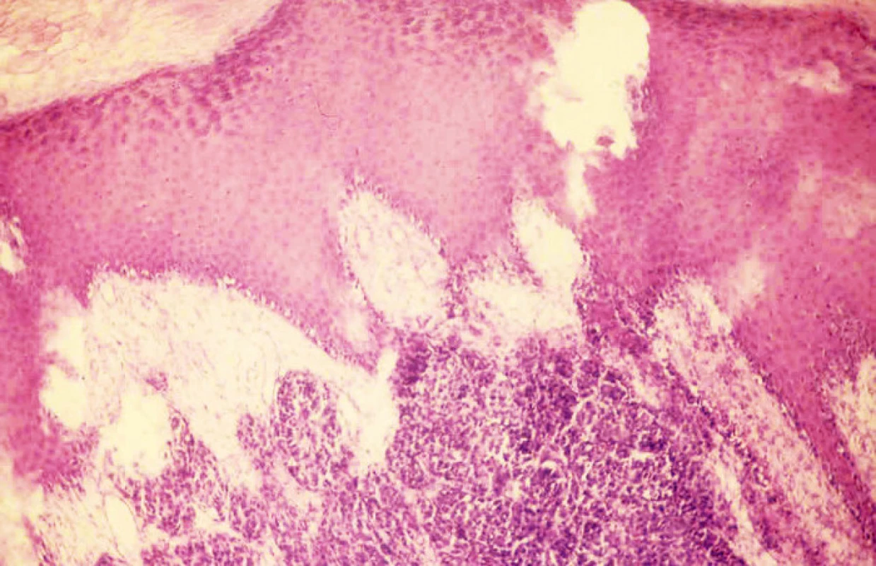 Nehtová ploténka a hřebeny nehtového lůžka, v dolní části korium s infiltrací akrolentiginózním melanomem. Hematoxylin-eozin, zvětšení l00x
Fig. 3. The nail plate with ridges of the nail bed, corium infilatrated with acrolentiginous melanoma, at the bottom. Hematoxylin- eosin, enlargement 100x