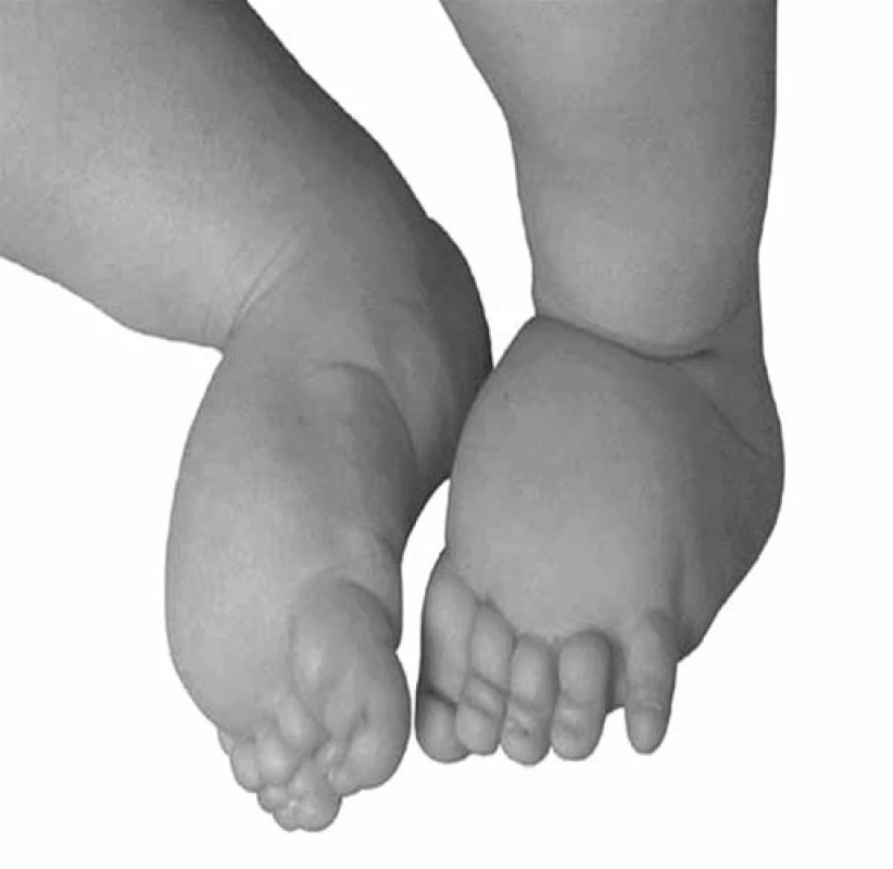 Lymfedém nártů u novorozence (archiv autorů).
Fig. 4. Lymphedema of insteps in a newborn (authors’ archive).