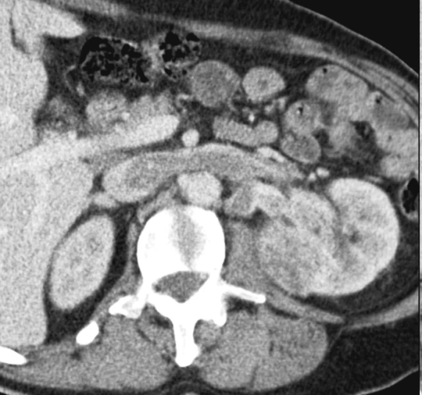 Multidetektorová výpočetní tomografie znázorňující ve venózní fázi nádorový trombus s propagací z renální žíly do retrohepatické části dolní duté žíly při konvenčním renálním karcinomu levé ledviny
Fig. 1. Venous-phase multidetector computed tomography imaging depicting the neoplastic thrombus spreading from the renal vein into the retrohepatic part of the inferior vena cava in conventional renal carcinoma of the left kidney