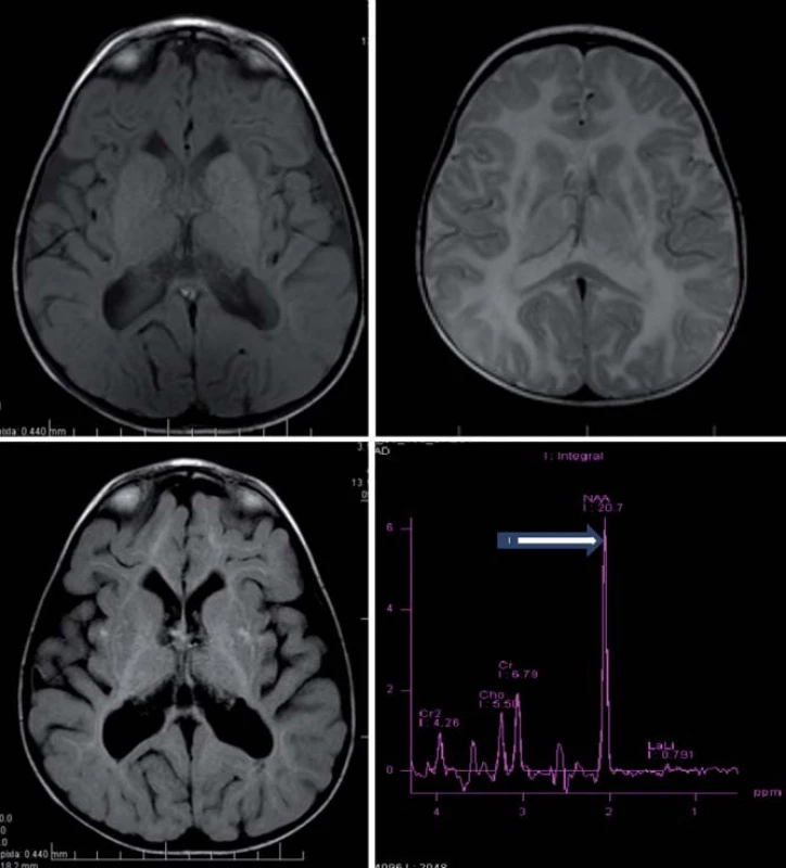Canavanovej leukodystrofia, 7,5-mesačné dieťa.
Obr. 4a, b) T1WI (a) a T2WI (b) – symetrické splývavé difúzne zmeny zvýšeného signálu s postihnutím U vláken.
Obr. 4c) FLAIR – nižšia intenzita signálu periférnej BH (vo veku 4 r.).
Obr. 4d) MRS – šípka označuje vysoký pík NAA.