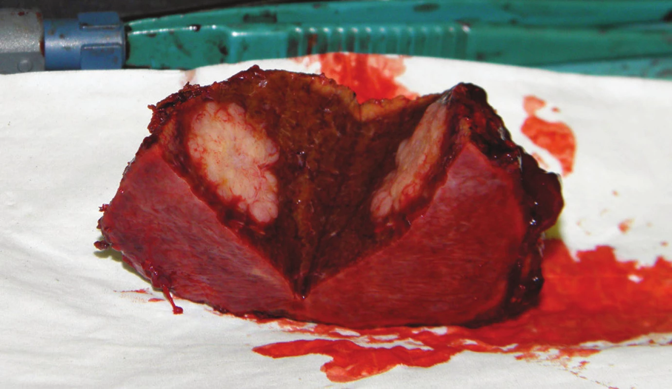 Operační nález: rozkrojený preparát po neanatomické resekci jater
Fig. 4: Intraoperative finding: a part of the liver with metastatic tumour