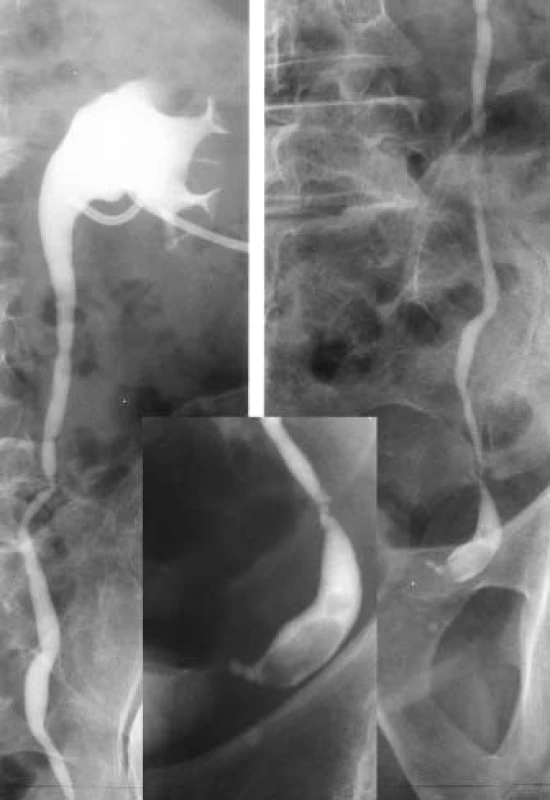 Distální nekontrastní ureterolitiáza (nástřik nefrostomického drénu -částečně mimo dutý systém).
