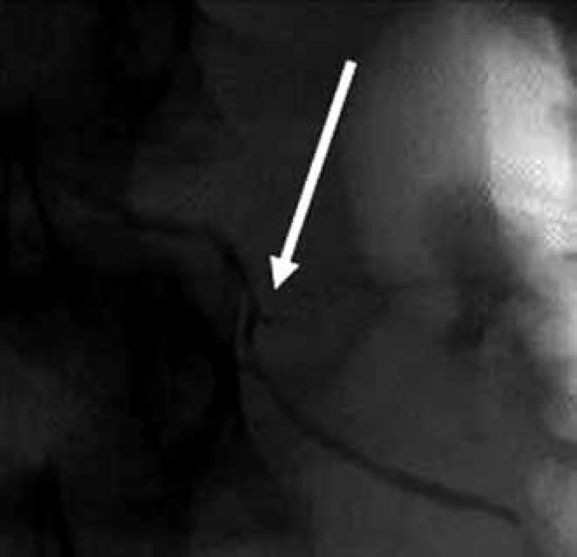 ERCP – únik kontrastní látky z pankreatického vývodu na přechodu hlavy a těla slinivky, pohled zezadu (šipka, detail).
Fig. 3. ERCP – leak of the contrast agent from the pancreatic duct between the pancreatic head and body, view from behind (arrow, detail).