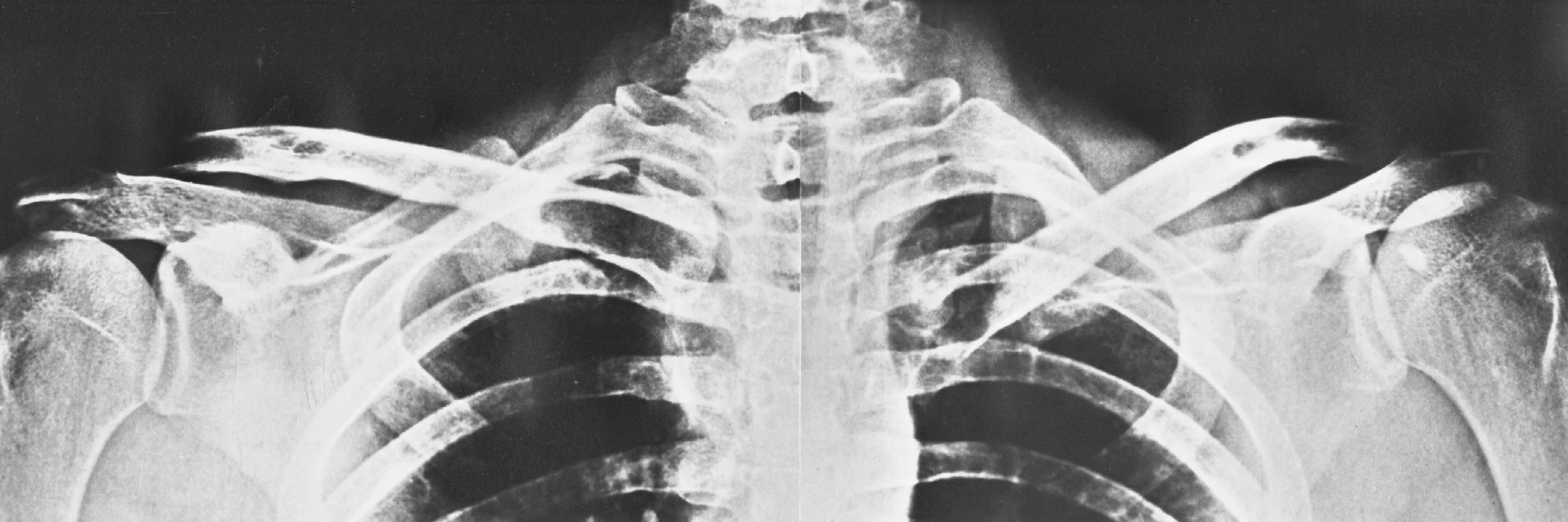 Srovnávací snímek obou SC kloubů ukazuje dislokovanou extraartikulární zlomeninu mediálního klíčku vlevo
Fig. 3. Comparative radiograph of both SC joints shows displaced extra-articular fracture of the medial end of the left clavicle
