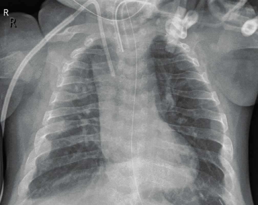 Rentgenogram hrudníku u téhož pacienta ve věku 13 měsíců po léčbě asfotázou alfa. Výrazné zlepšení mineralizace skeletu (obrázek z archivu prof. MUDr. Z. Šumníka, Ph.D.).
Fig. 2. Chest X-ray of the same patient at the age of 13 months after asfotase treatment. Note significant skeletal remineralisation.
