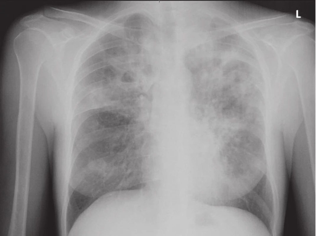 RTG snímek plic matky při přijetí na infekční oddělení.
Fig. 1. Chest X-ray of mother on admission.