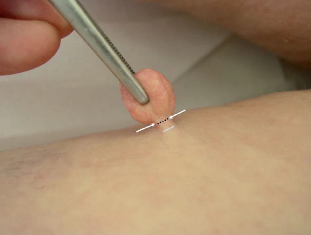 Metóda vysokej elektrokauterovej shave-excízie