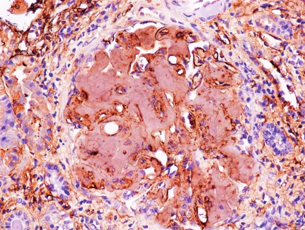 Imunohistochemie – fibrinogen, zvětšení 200x
Pozitivita amyloidových depozit v glomerulu ledviny
(Poskytnuto MUDr. Pavlou Látalovou, Ústav klinické a molekulární patologie, Fakultní nemocnice Olomouc.)