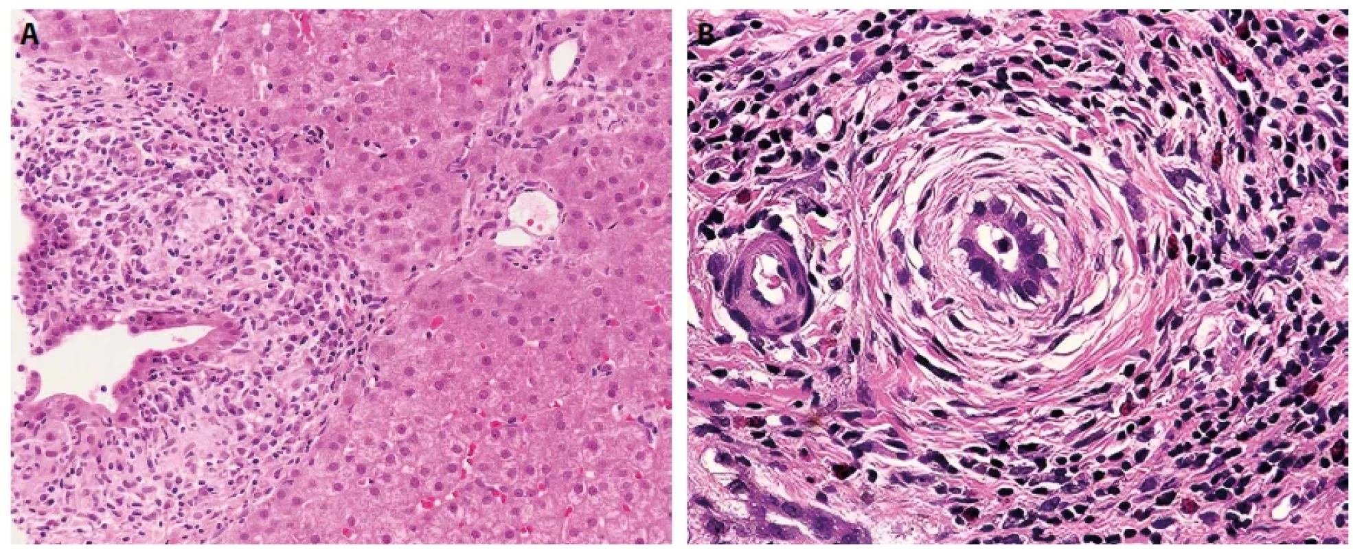 Biliární léze indukovaná inhibitory imunitních kontrolních bodů. Periduktální granulomatózní reakce (A) a fibrózní cholangiopatie (B). Barveno hematoxylinem eozinem (zvětšení 200x).
