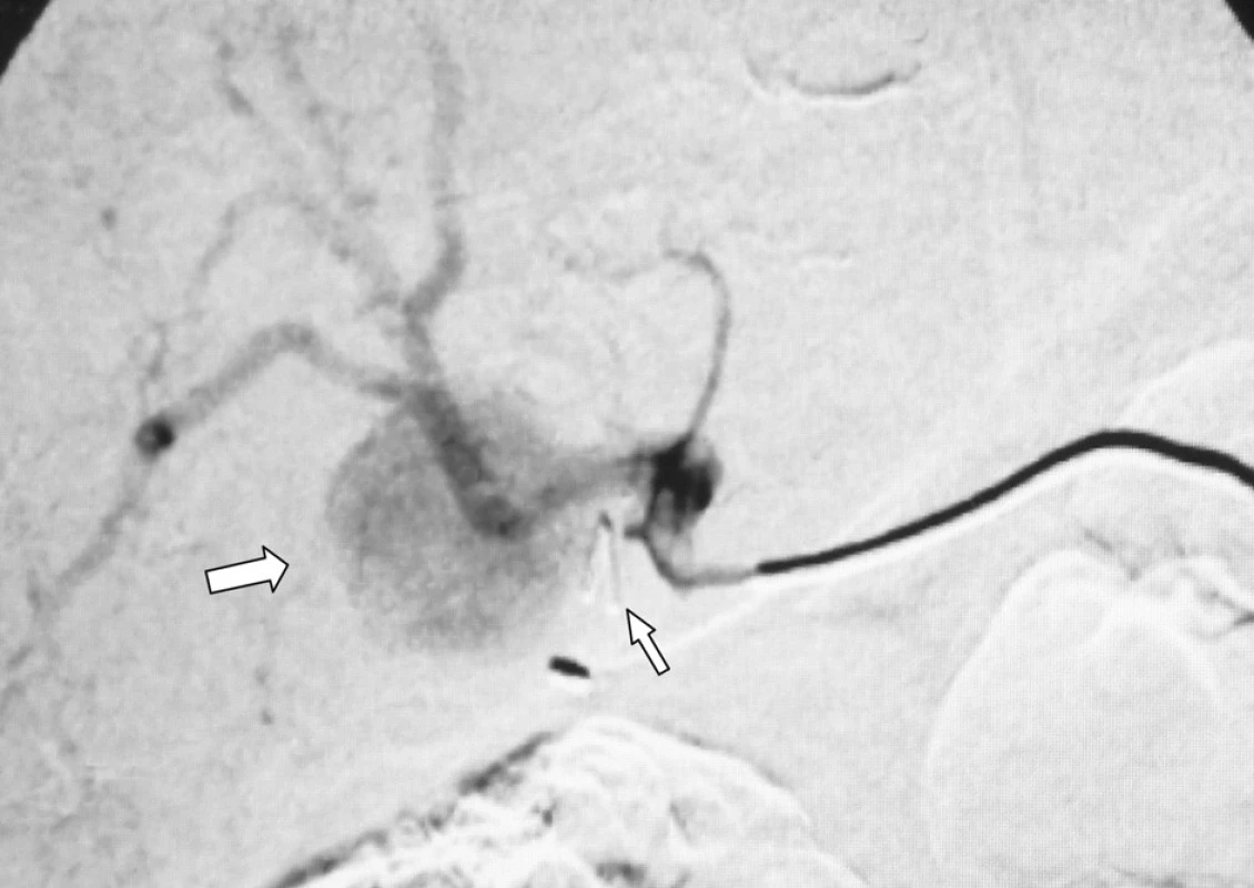 Angiografie truncus coeliacus: aneurysma pravé větve a. hepatica (silnější šipka vlevo) a klip nasazený při laparoskopické cholecystektomii (slabší šipka vpravo)
Fig. 3. Angiography of the truncus coeliacus: an aneurysm of the right hepatic artery (a bold arrow on the left) and a clip applied during the laparoscopic cholecystectomic procedure (a thinner arrow on the left)