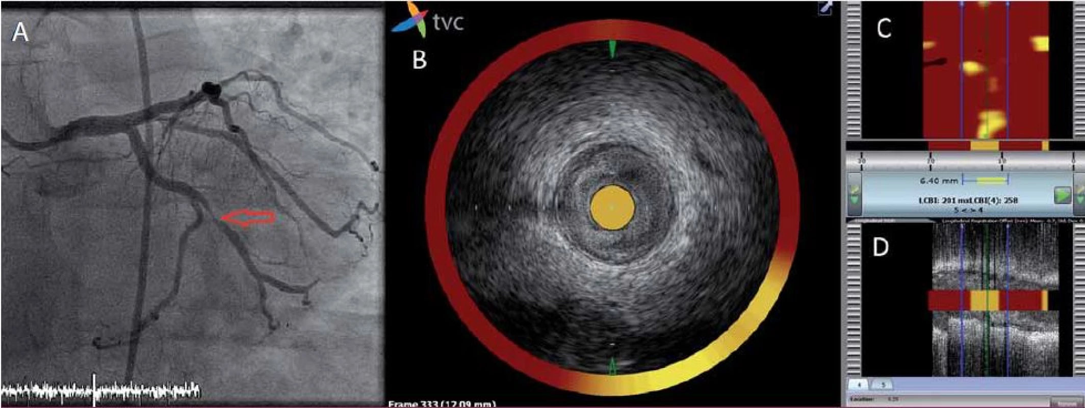 Analýza aterosklerotického plátu pomocí NIRS-IVUS.