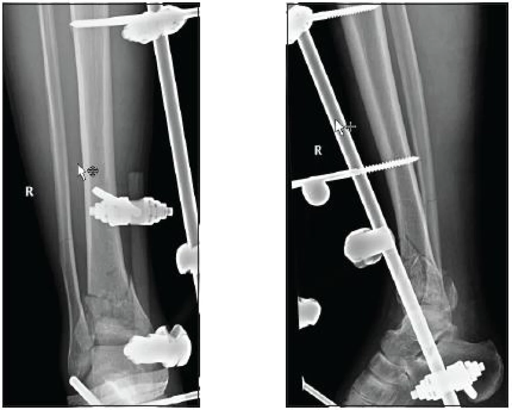 Stav po osteosyntéze přemosťujícím zevním fixatérem (KÚCH)