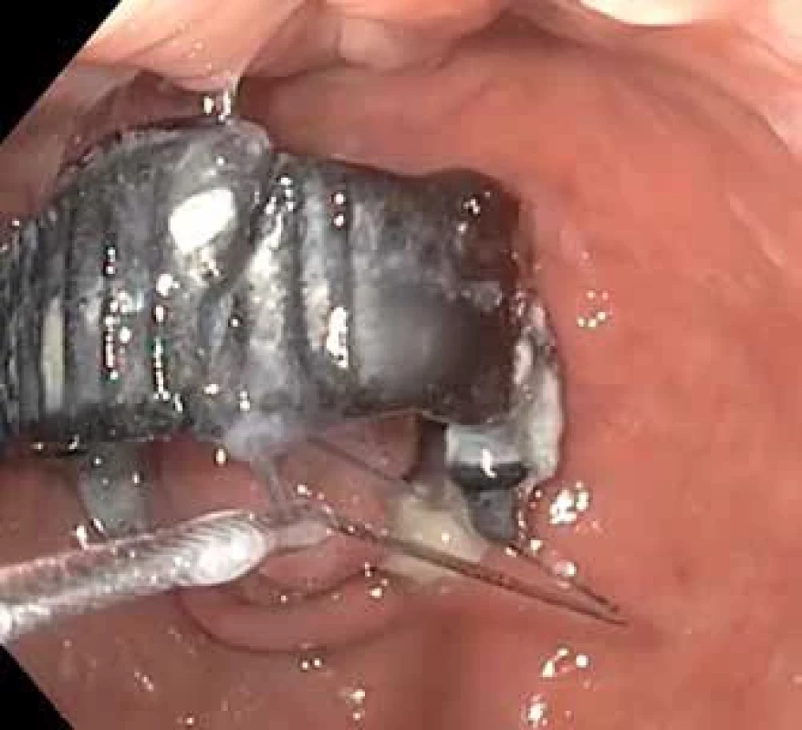 Proříznutý Fobi ring [15].