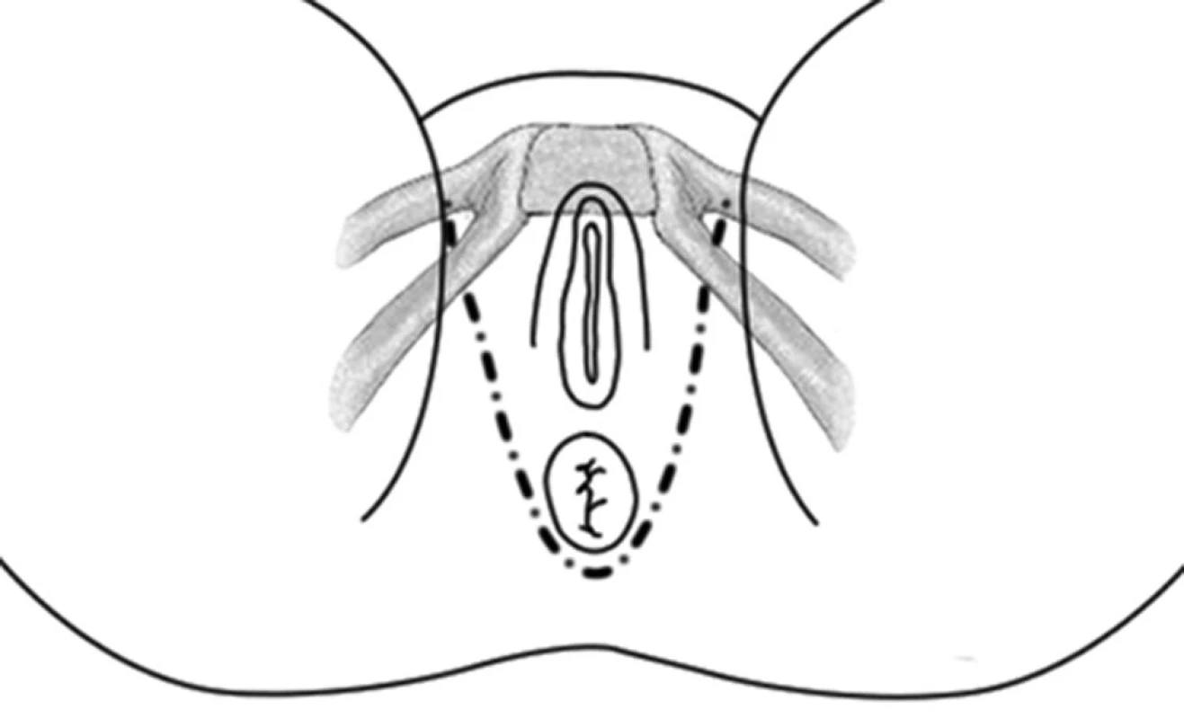 Schéma umístění pásky
Fig. 1: Outline of the anal sling position