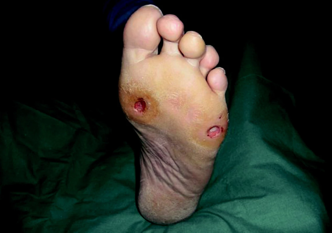 Neuropatické ulcerace.