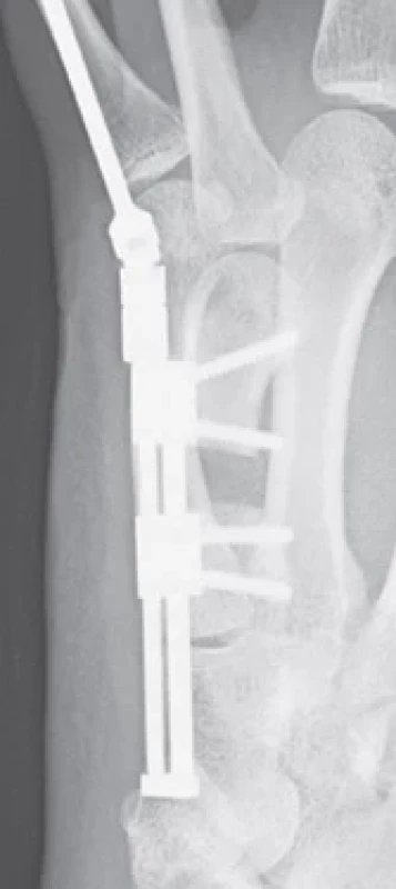Postoperative clinical view showing skin incisions and external activator in place.