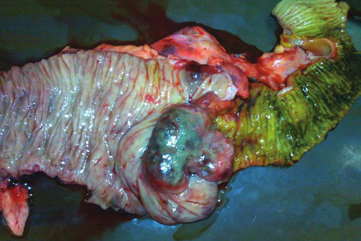 Resekovaná část ileocekálního přechodu s tumorem
Fig. 1: Resected part of the terminal ileum and caecum with tumor
