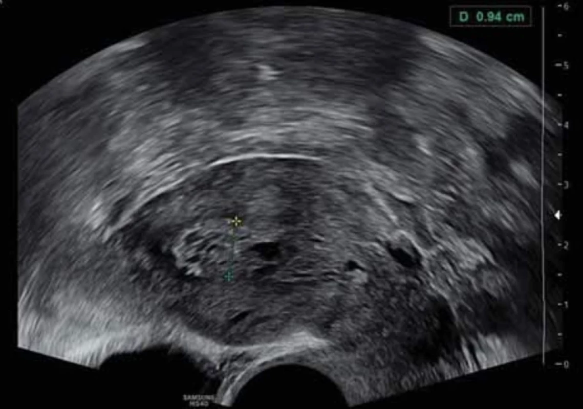 Endometriální polyp cystického vzhledu u postmenopauzální pacientky. // Cystic endometrial polyp in postmenopausal patient.
