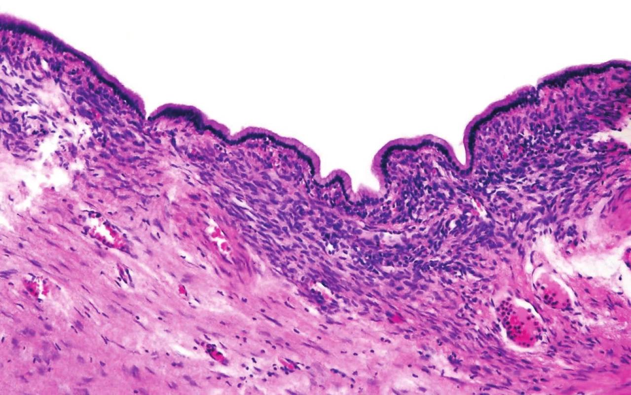 Cysty jsou vystlány jednovrstevným hlenotvorným cylindrickým epitelem nasedajícím na bazální membránu. Subepiteliálně mezenchymální ovarian-like stroma; vnější vrstva tvořena denzním hyalinizovaným vazivem
Fig. 2. The cysts are lined with one-layer muciparous columnar epithelium which adjoins the basal lamina.Sub-epithelially mesenchymal ovarian-like stroma: the outer layer consist of dense hyalinized fibrous tissue