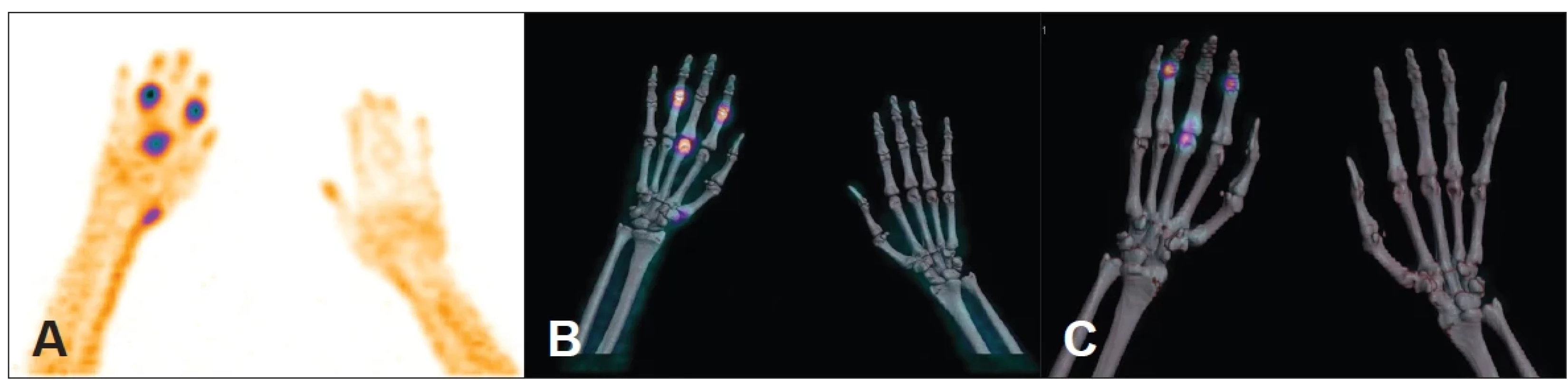 Třífázové vyšetření skeletu u dekompenzované artrózy pravé ruky. Na obrázku je první fáze vyšetření skeletu (A). Volume Rendering Technique (VRT) a MIP zobrazení SPECT/CT druhé fáze (B) a VRT/MIP třetí (kostní) fáze vyšetření (C).