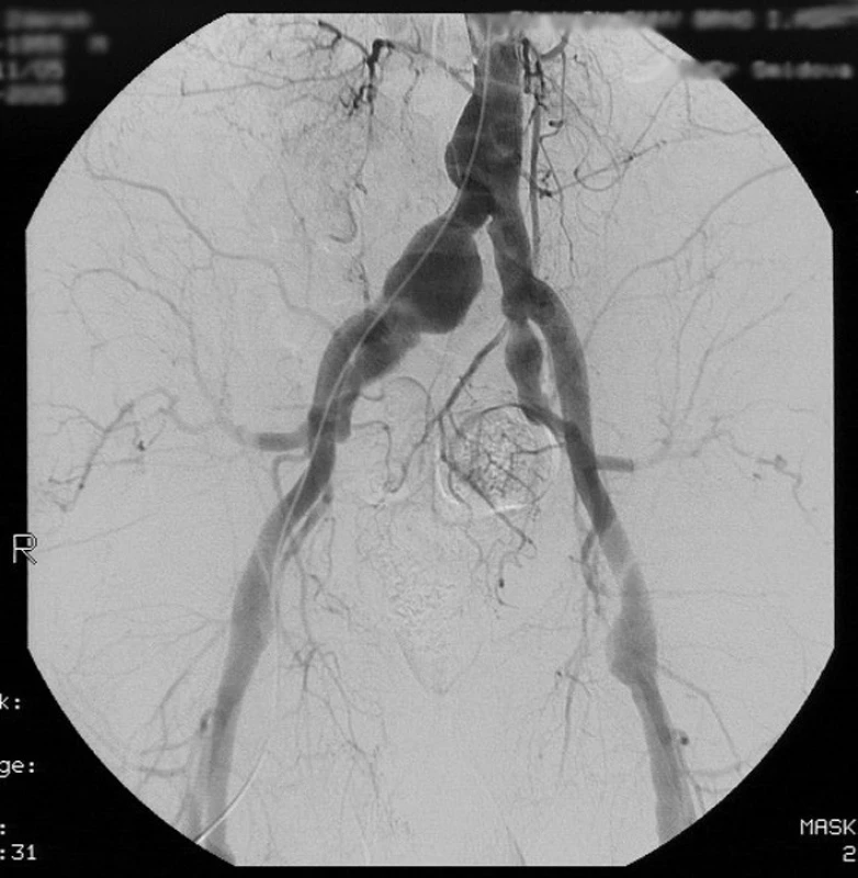 Digitální subtrakční angiografie abdominální aorty a pánevních tepen. Je viditelné komplexní aneuryzmatické postižení tepenného řečiště.
Pic. 1. Digital subtraction angiography of the abdominal aorta and iliac arteries. It shows complex aneurysmatic alteration of arterial bed.