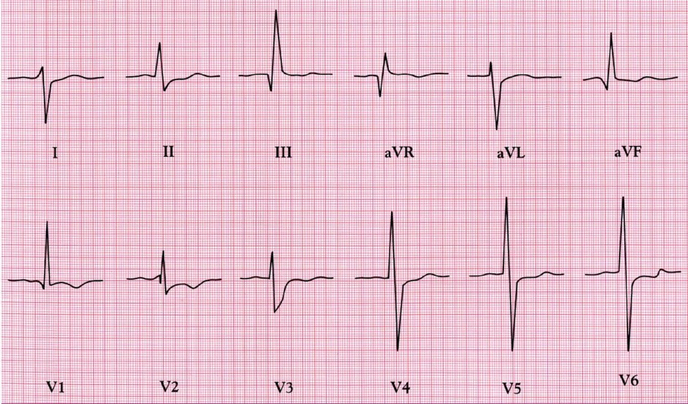EKG při Eisenmengerově reakci – deviace osy doprava, dominantní kmity R a invertované vlny T v pravých hrudních svodech, a hluboké kmity S ve V5 a V6. NB: 1mV = 0,5 cm.